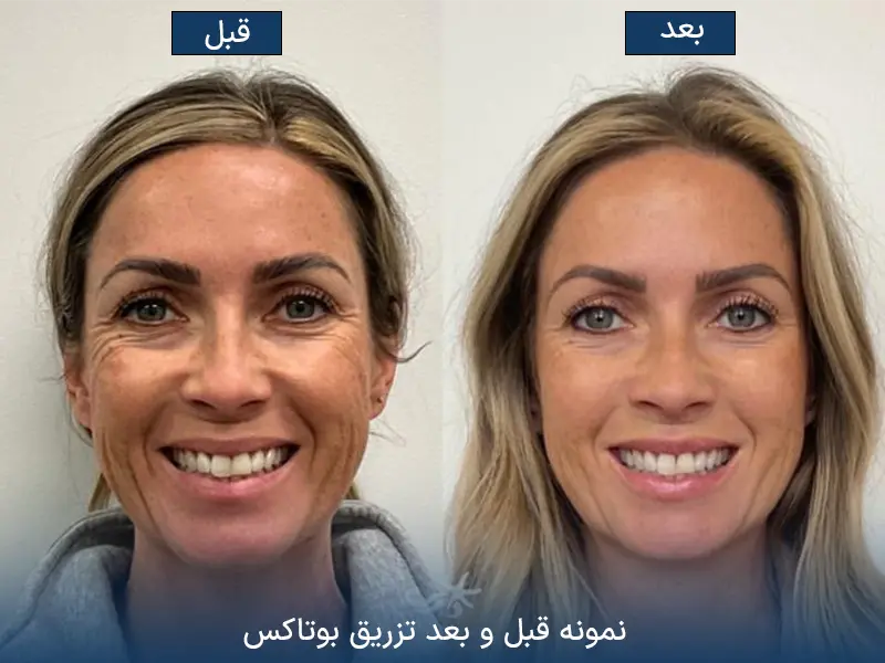قبل و بعد از تزریق بوتاکس صورت