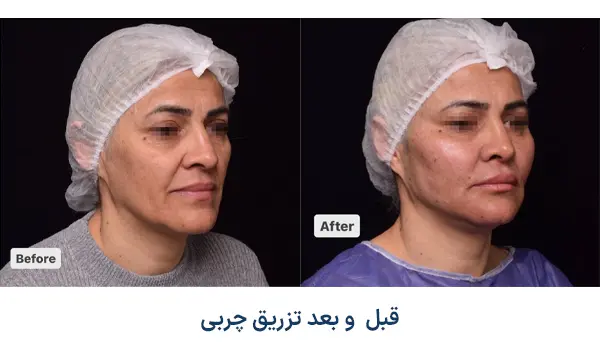 نمونه قبل و بعد تزریق چربی
