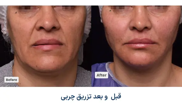 قبل و بعد تزریق چربی