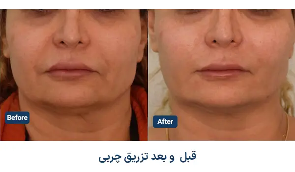 نمونه قبل و بعد تزریق چربی در آرت اسکین