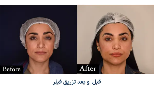 نمونه قبل و بعد تزریق فیلر