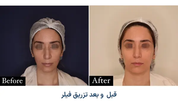 قبل و بعد تزریق فیلر در آرت اسکین