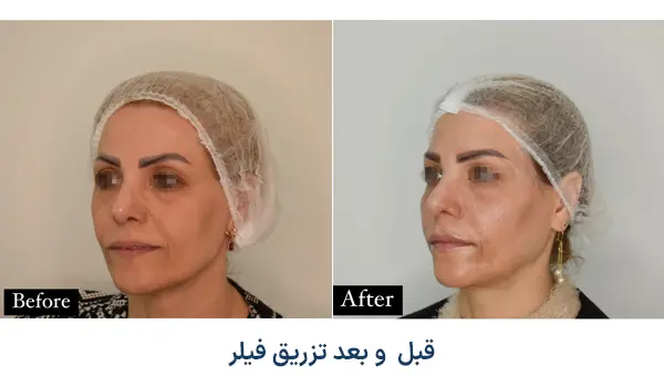 نمونه تزریق فیلر در آرت اسکین