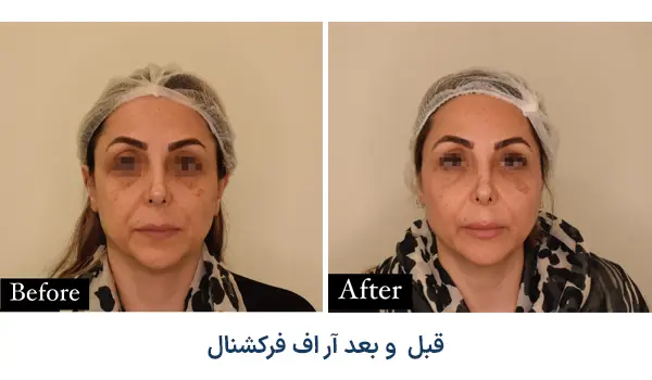 نمونه قبل و بعد آر اف فرکشنال در آرت اسکین