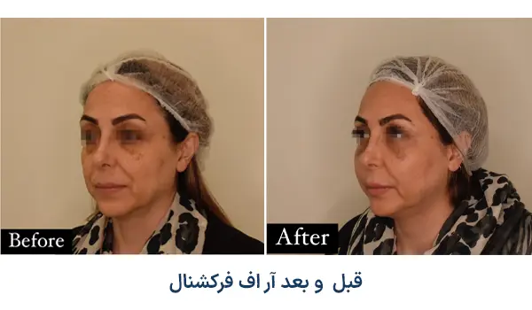 نمونه قبل و بعد ار اف فرکشنال