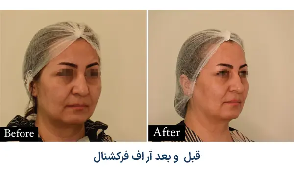 نمونه قبل و بعد ار اف فرکشنال
