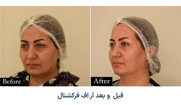 نمونه قبل و بعد لیزر ار اف فرکشنال