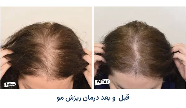 درمان ریزش مو با prp