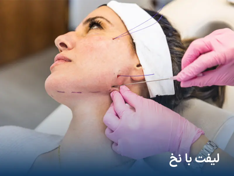 لیفت با نخ در آرت اسکین