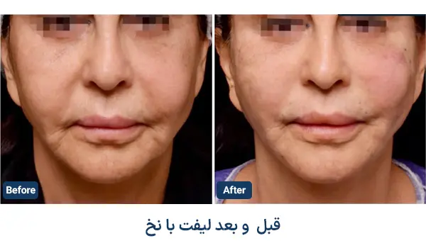 نمونه قبل و بعد لیفت با نخ