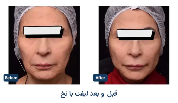 نمونه لیفت با نخ